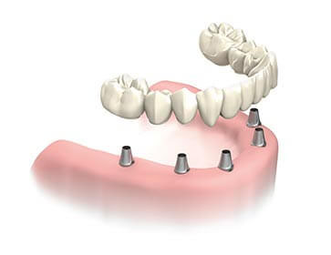 dental-implants-abutment-crown